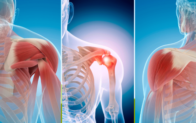 WorkCover payouts for shoulder injuries